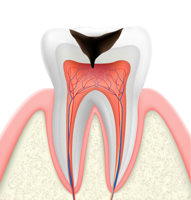 C3歯の神経の虫歯